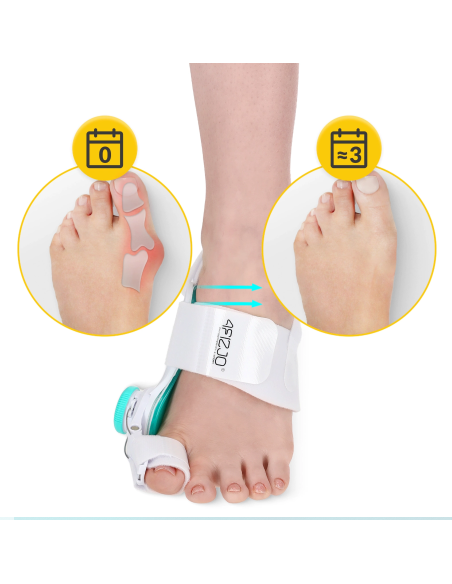 Korekcinis prietaisas nuo bunionų deformacijos